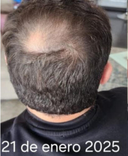 TRATAMIENTO CRECIMIENTO DE CABELLO
